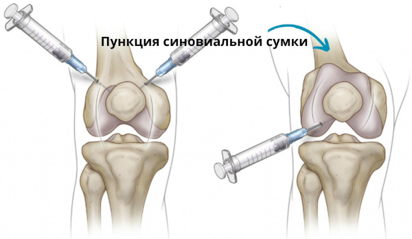 Почему щелкают суставы по всему телу, что делать