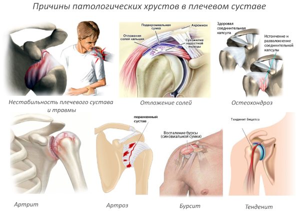 Почему щелкают суставы по всему телу, что делать