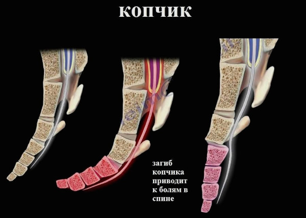 После долгого сидения больно вставать и идти. Болит поясница, копчик, ноги, суставы