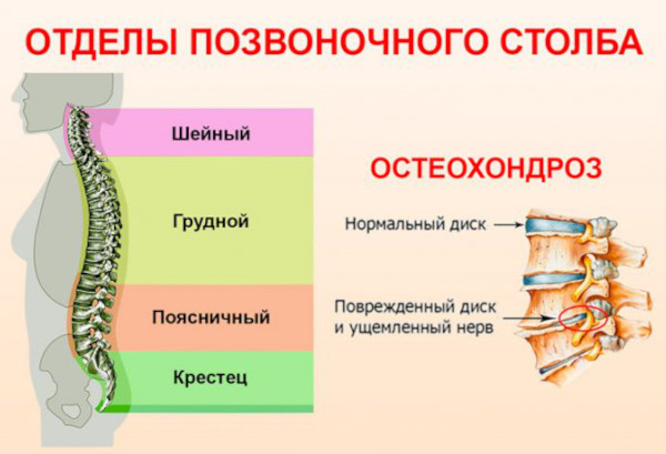 Смещение позвонков грудного отдела. Симптомы, лечение, упражнения