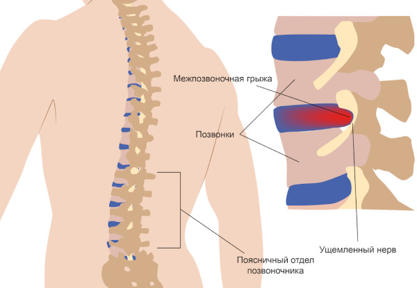 При грыже позвоночника лучше покой или движение. Что нельзя делать