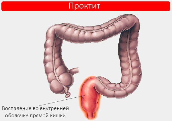 Проктологические заболевания. Список, симптомы, лечение