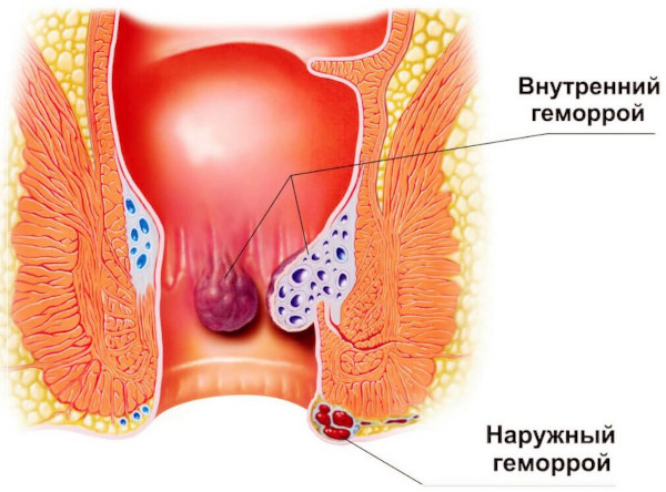 Проктологические заболевания. Список, симптомы, лечение