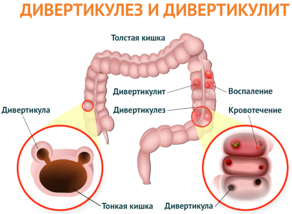 Проктологические заболевания. Список, симптомы, лечение