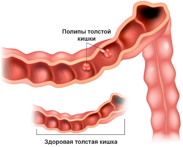 Проктологические заболевания. Список, симптомы, лечение