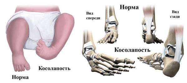 Ребенок косолапит при ходьбе. Лечение, упражнения, массаж