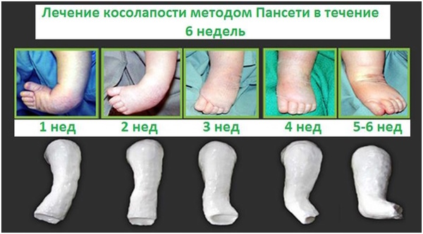 Ребенок косолапит при ходьбе. Лечение, упражнения, массаж