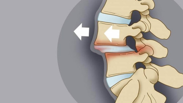 Ретролистез позвонка поясничного, шейного отдела. Что это такое, последствия