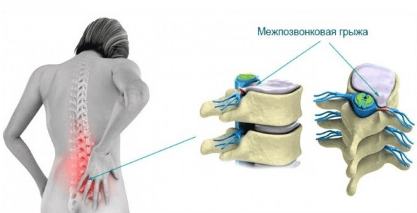 Ретролистез позвонка поясничного, шейного отдела. Что это такое, последствия