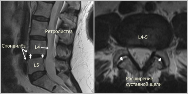 Ретролистез позвонка поясничного, шейного отдела. Что это такое, последствия