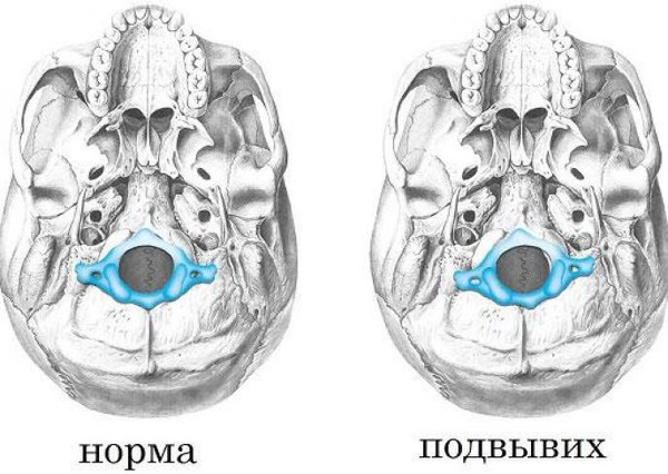 Ротационный подвывих атланта у детей, смещение, симптомы