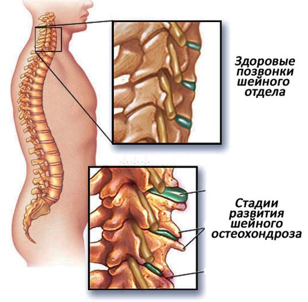 Левосторонний сколиоз поясничного отдела позвоночника 1-2 степени