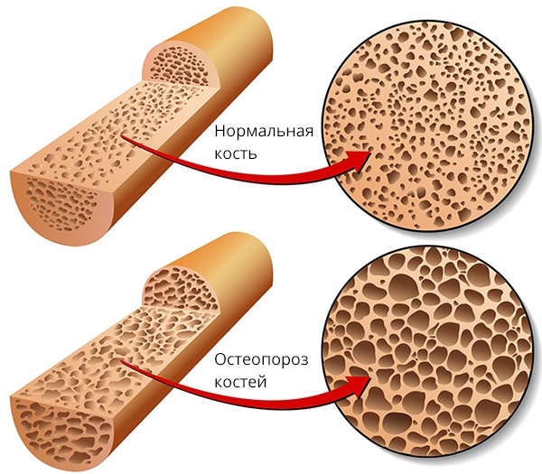 Сенильный остеопороз. Что это такое, лечение