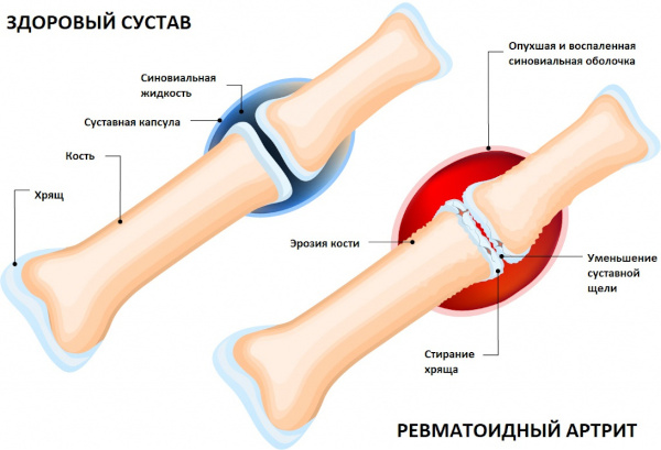 Шишки на пальцах рук: на суставах, большом, указательном пальце, наросты, косточки