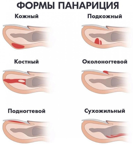 Шишки на пальцах рук: на суставах, большом, указательном пальце, наросты, косточки