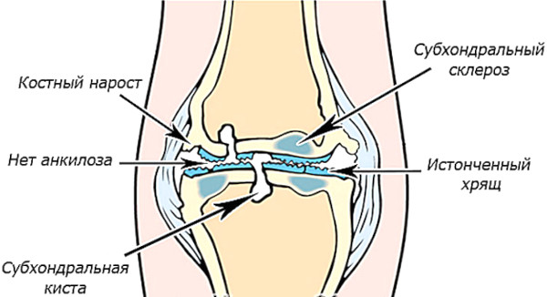 Субхондральный остеосклероз. Что это такое, лечение