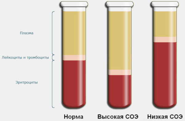 Субхондральный остеосклероз. Что это такое, лечение