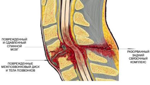 Ушиб поясничного отдела позвоночника. Симптомы, лечение у взрослых