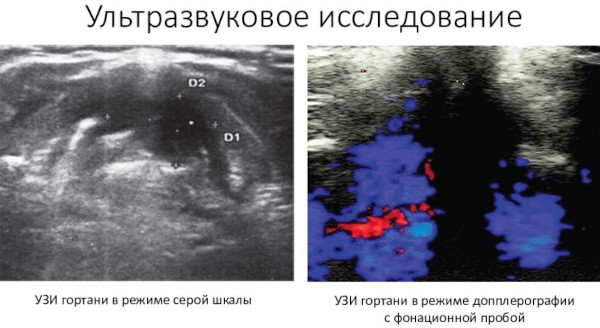 УЗИ горла и гортани. Что показывает у взрослого, ребенка