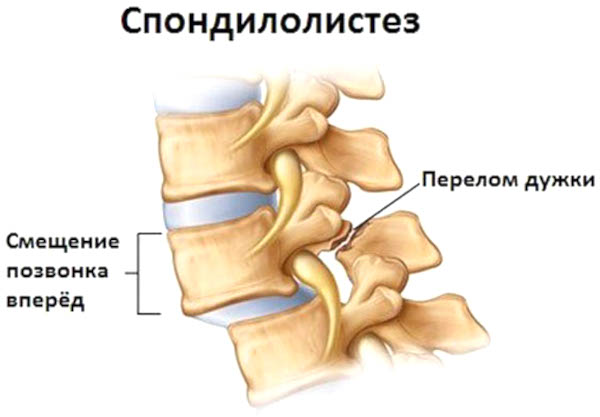 Выступающий позвонок. Выпирает позвонок на шее сзади, как убрать