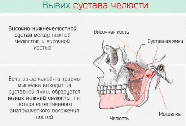 Вывих челюсти нижней, верхней. Симптомы, как вправить, что делать