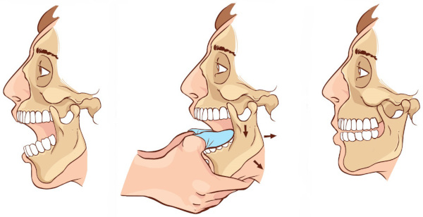 Вывих челюсти нижней, верхней. Симптомы, как вправить, что делать