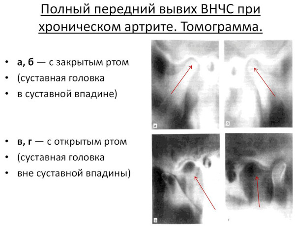 Вывих челюсти нижней, верхней. Симптомы, как вправить, что делать