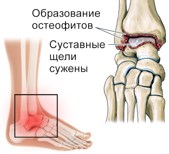 Вывих голеностопного сустава. Симптомы, первая помощь, лечение