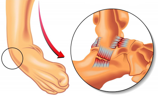 Вывих голеностопного сустава. Симптомы, первая помощь, лечение