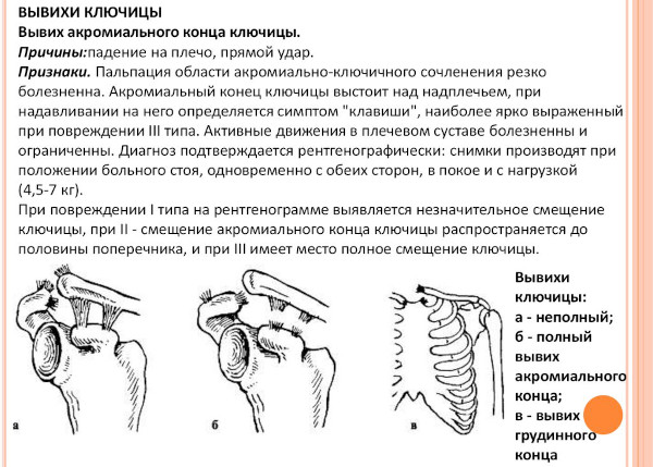 Вывих ключицы акромального конца. Симптомы, лечение, вправление