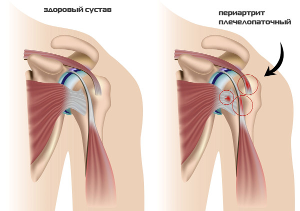 Вывих ключицы акромального конца. Симптомы, лечение, вправление