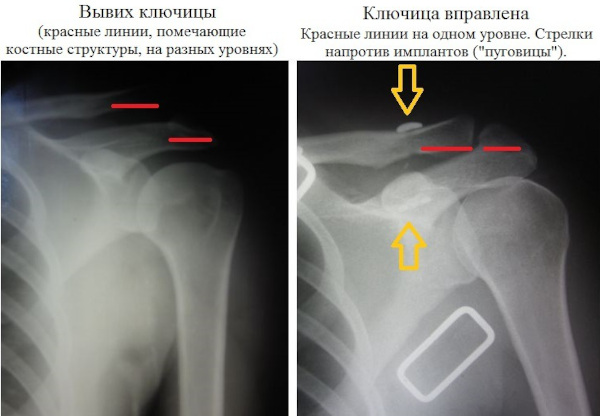 Вывих ключицы акромального конца. Симптомы, лечение, вправление