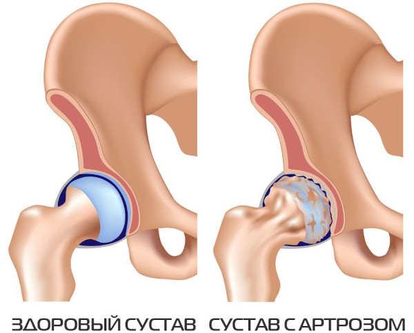 Вывих тазобедренного сустава у взрослых. Симптомы и лечение