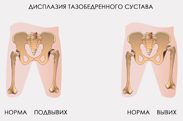 Вывих тазобедренного сустава у взрослых. Симптомы и лечение