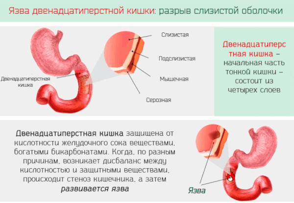 Заболевания кишечника, симптомы и признаки болезни. Список