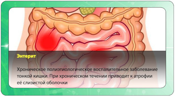 Заболевания кишечника, симптомы и признаки болезни. Список