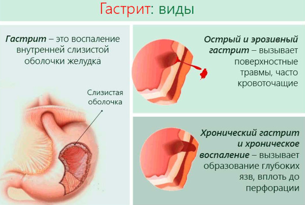 Заболевания кишечника, симптомы и признаки болезни. Список