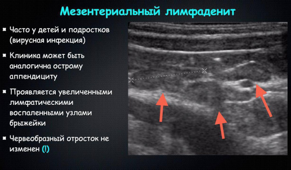 Заболевания кишечника, симптомы и признаки болезни. Список