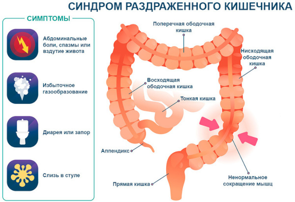 Заболевания кишечника, симптомы и признаки болезни. Список