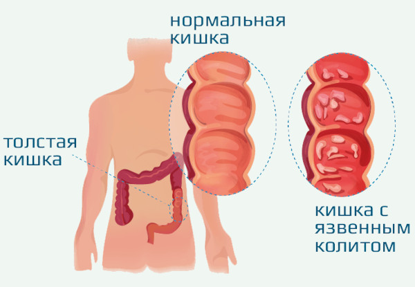 Заболевания кишечника, симптомы и признаки болезни. Список