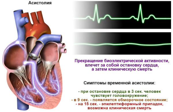 Асистолия сердца. Что это такое, симптомы, лечение