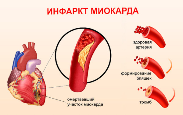 Асистолия сердца. Что это такое, симптомы, лечение