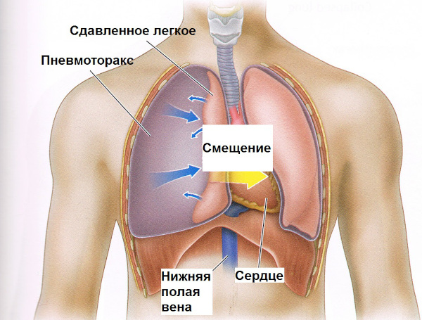 Асистолия сердца. Что это такое, симптомы, лечение