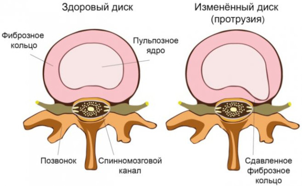 Гиполордоз поясничного отдела позвоночника. Что это, лечение