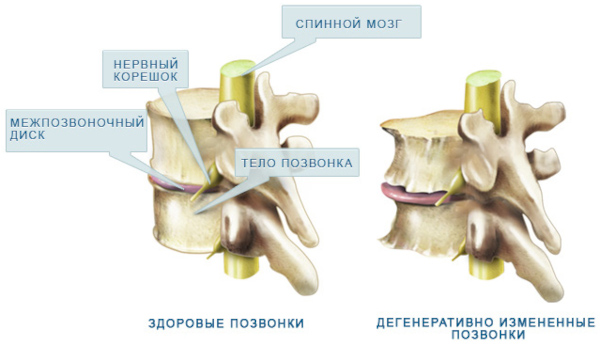 Гиполордоз поясничного отдела позвоночника. Что это, лечение