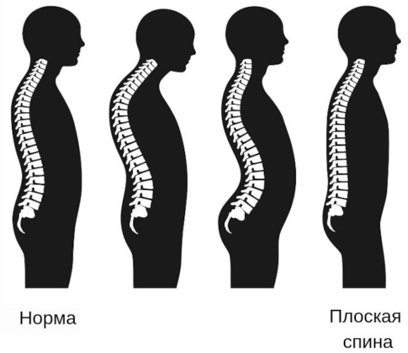 Гиполордоз поясничного отдела позвоночника. Что это, лечение