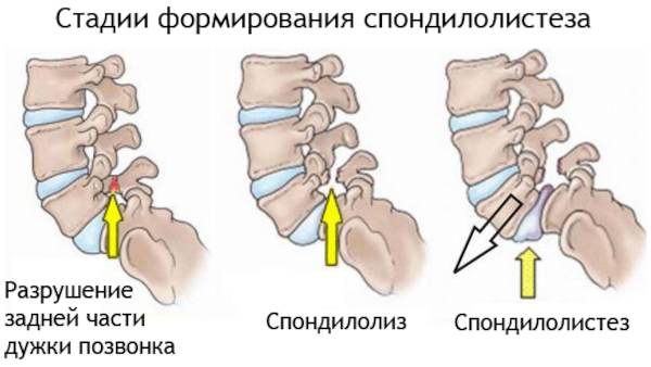 Хрустит позвоночник при поворотах туловища и шеи, выпрямлении спины