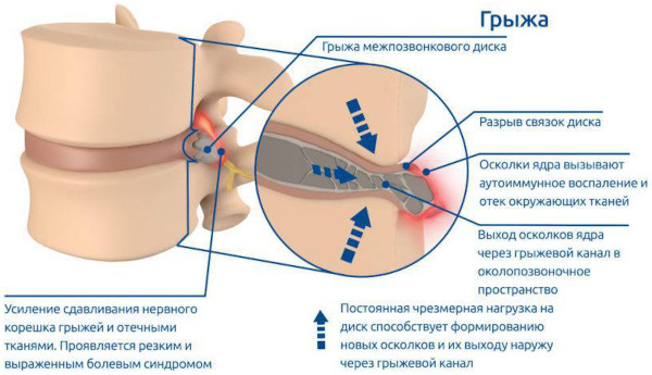 Межпозвоночные диски. Строение, анатомия, функции