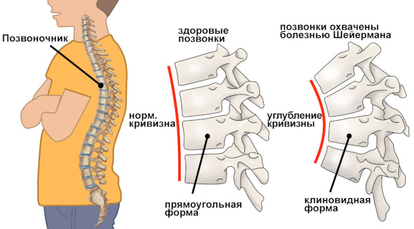 Межпозвоночные диски. Строение, анатомия, функции