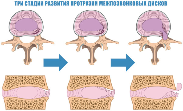 Межпозвоночные диски. Строение, анатомия, функции